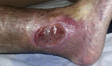 pakistaní Marty Fielding roto Tratamiento: Úlceras en piernas | Medicina y Estética Salta, Argentina
