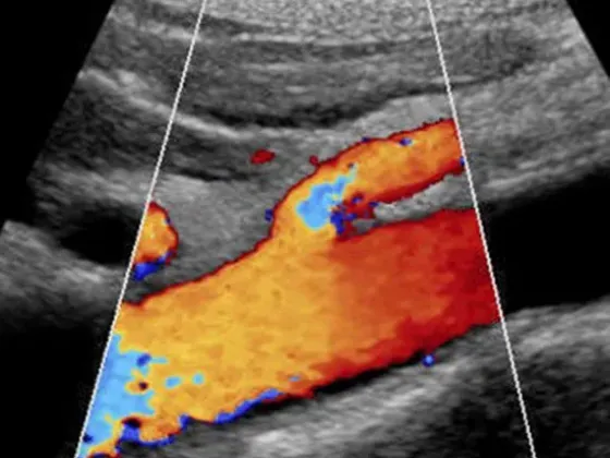 Estudio doppler color aorta