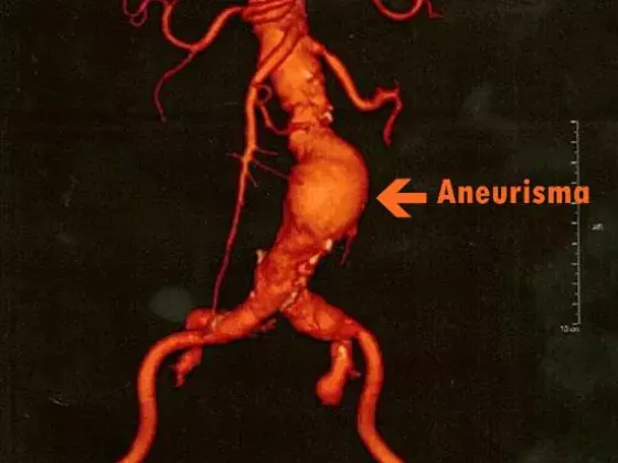 Angiotomografía de aorta