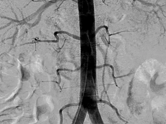Angiografía digital de aorta