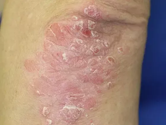 Psoriasis y enfermedades inflamatorias