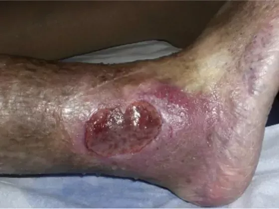 Úlceras en piernas